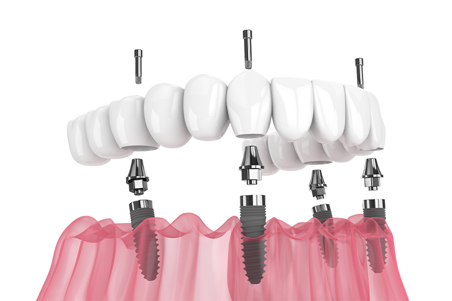 オールオン4のメリット・デメリット
